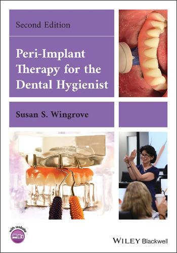 Peri�Implant Therapy for the Dental Hygienist