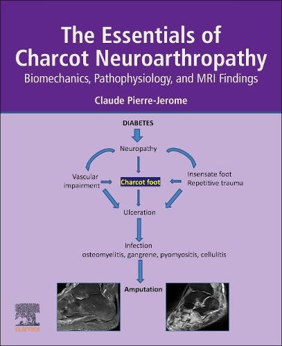 The Essentials of Charcot Neuroarthropathy: Biomechanics, Pathophysiology, and MRI Findings